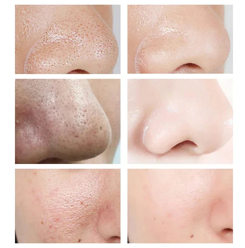 Crème rétrécissante pour les pores à l'acide salicylique, élimine les grands Pores, sérum, élimine les points noirs, répare l'acné, raffermissement, soins pour la peau, cosmétiques