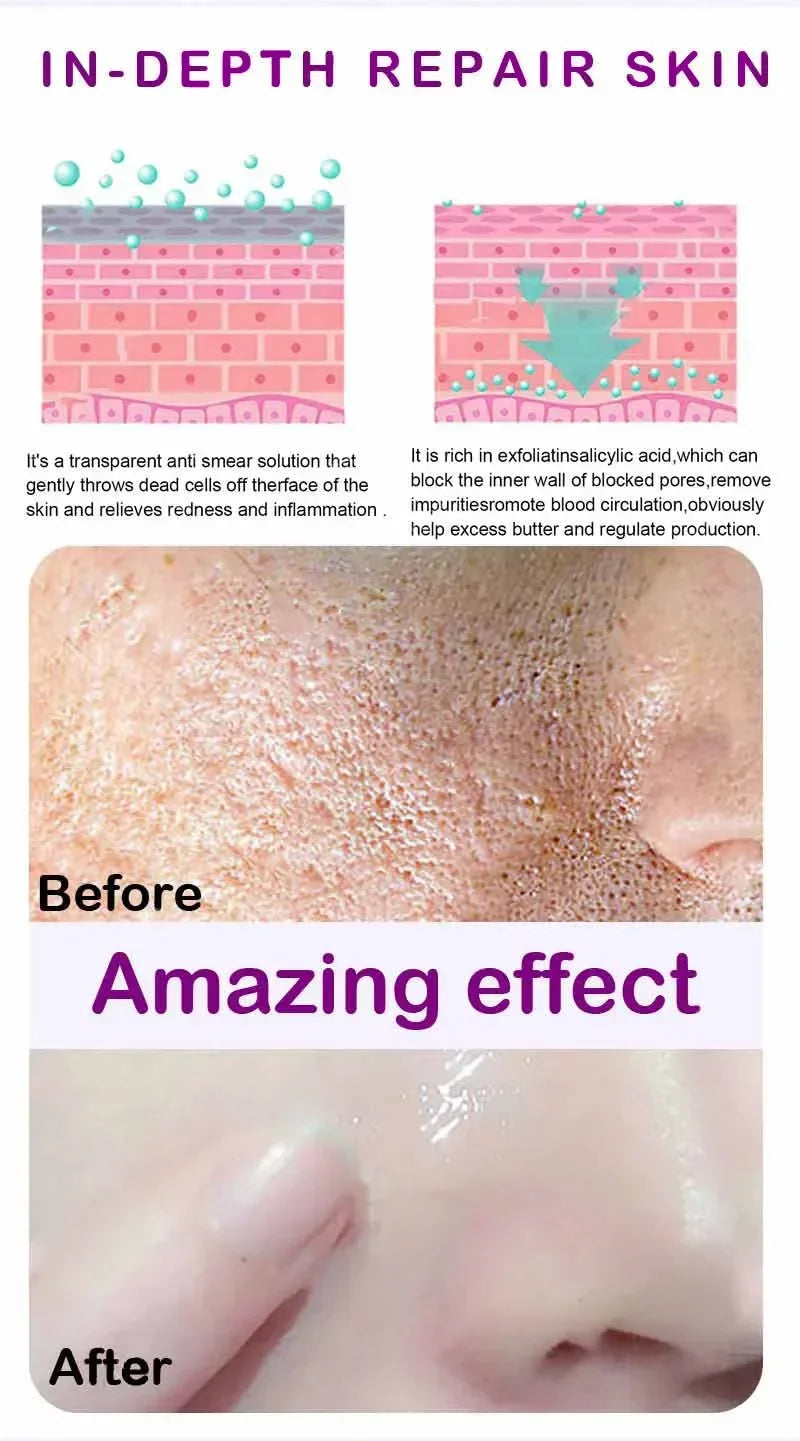 Texture de peau |   Sérum visage éclaircissant pour raffinage des pores, resurfaçage, au rétinol et à la niacinamide non comédogène