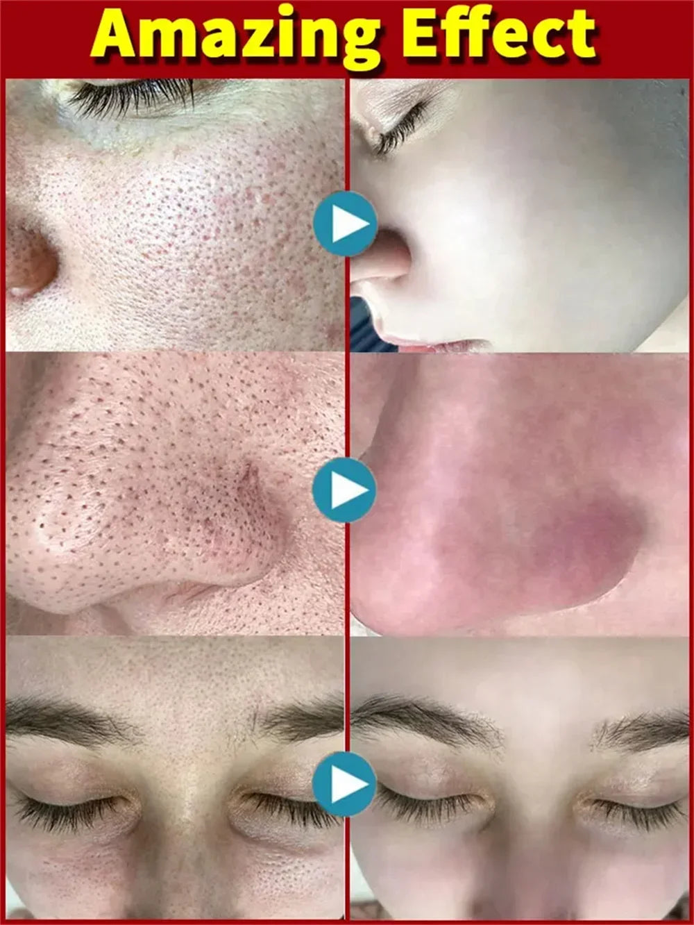 Crème rétrécissante pour les pores à l'acide salicylique, élimine les grands Pores, sérum, élimine les points noirs, répare l'acné, raffermissement, soins pour la peau, cosmétiques