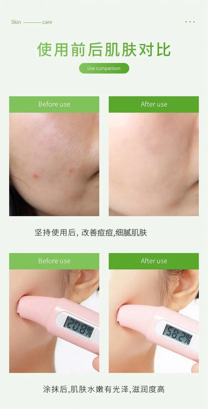 Gel éclaircissant pour la peau, crème anti-acné, gel après-soleil, 260ml