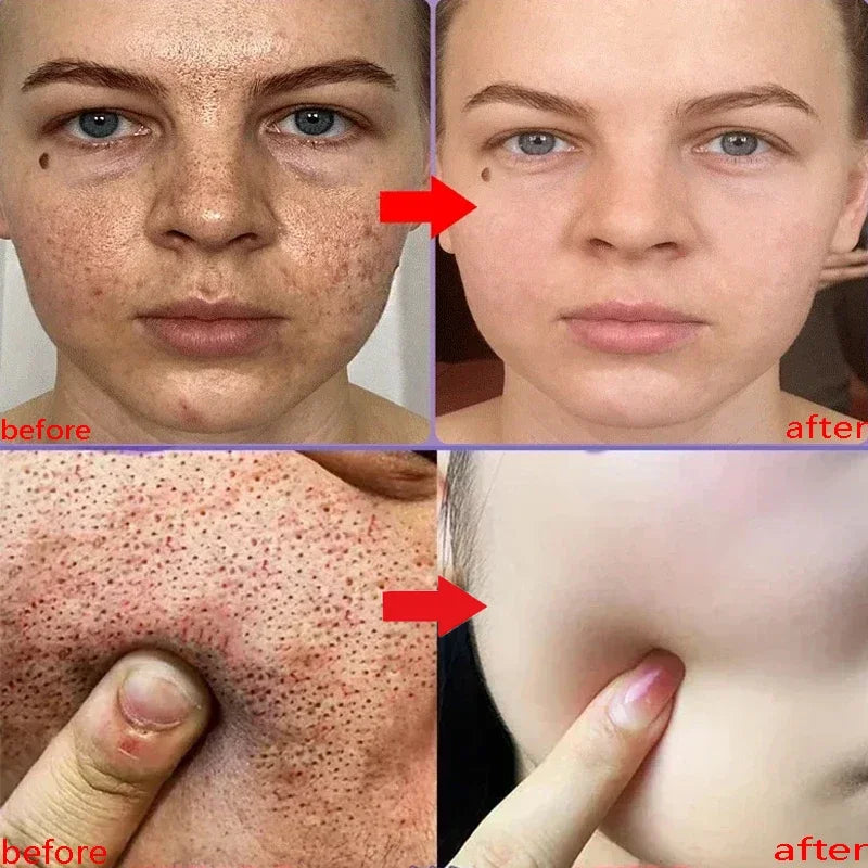 Crème rétrécissante pour les pores à l'acide salicylique, élimine les grands Pores, sérum, élimine les points noirs, répare l'acné, raffermissement, soins pour la peau, cosmétiques