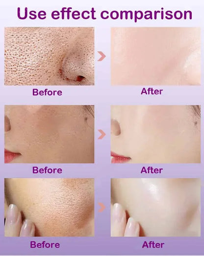 Texture de peau |   Sérum visage éclaircissant pour raffinage des pores, resurfaçage, au rétinol et à la niacinamide non comédogène