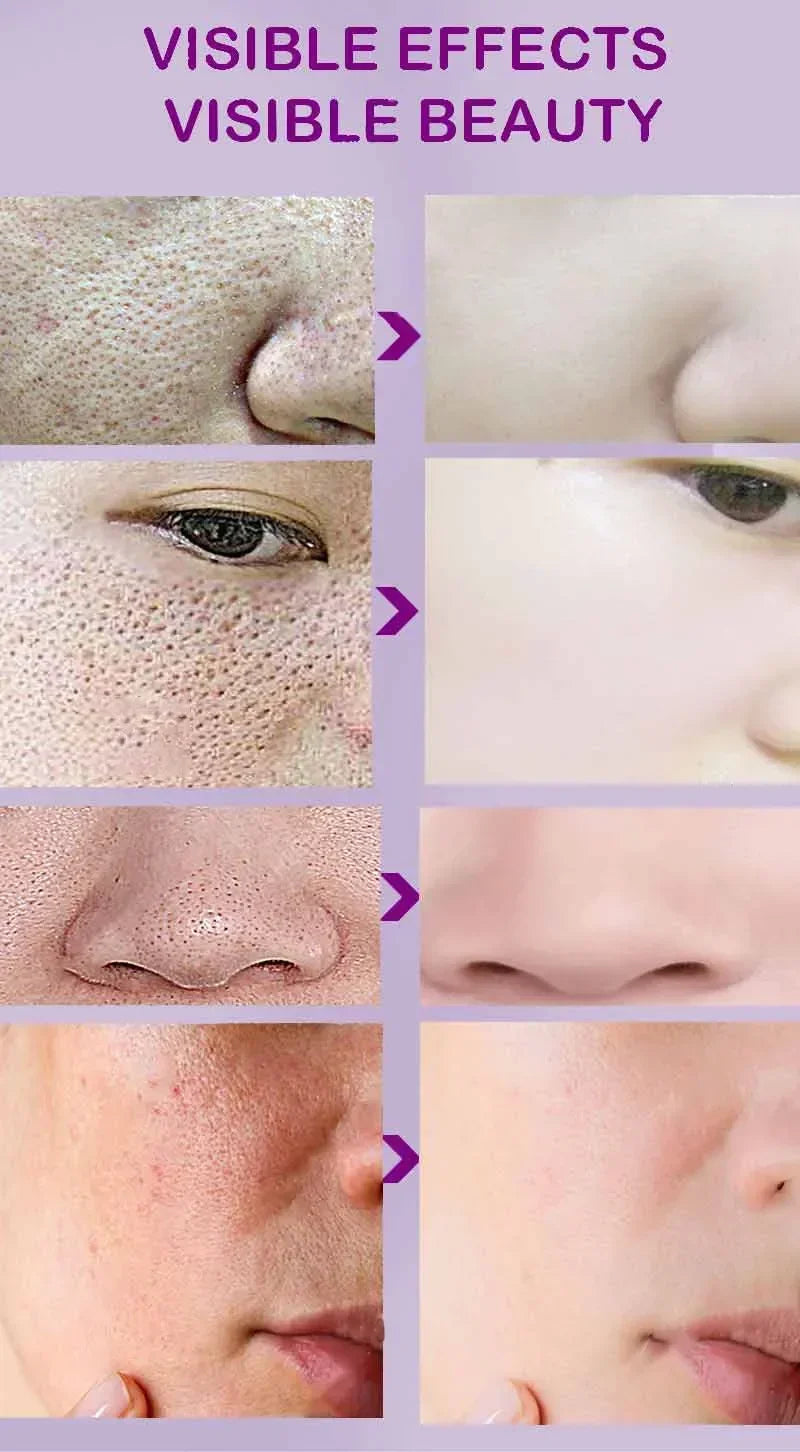 Texture de peau |   Sérum visage éclaircissant pour raffinage des pores, resurfaçage, au rétinol et à la niacinamide non comédogène