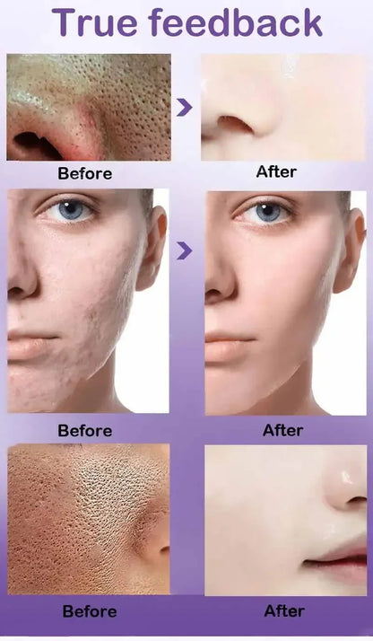 Texture de peau |   Sérum visage éclaircissant pour raffinage des pores, resurfaçage, au rétinol et à la niacinamide non comédogène