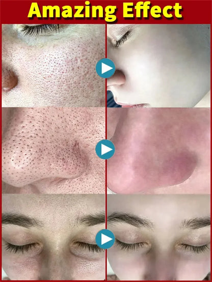 Crème rétrécissante pour les pores à l'acide salicylique, élimine les grands Pores, sérum, élimine les points noirs, répare l'acné, raffermissement, soins pour la peau, cosmétiques