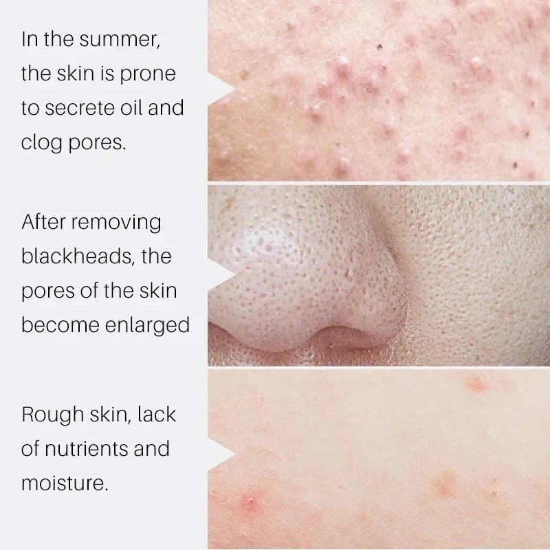 Crème rétrécissante pour les pores à l'acide salicylique, élimine les grands Pores, sérum, élimine les points noirs, répare l'acné, raffermissement, soins pour la peau, cosmétiques